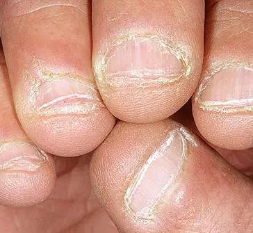 Poobgryzane paznokcie