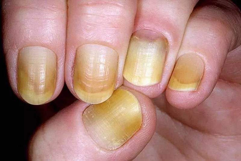 Zółte paznokcie