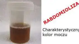 Rabdomioliza - charakterystyczny kolor moczu
