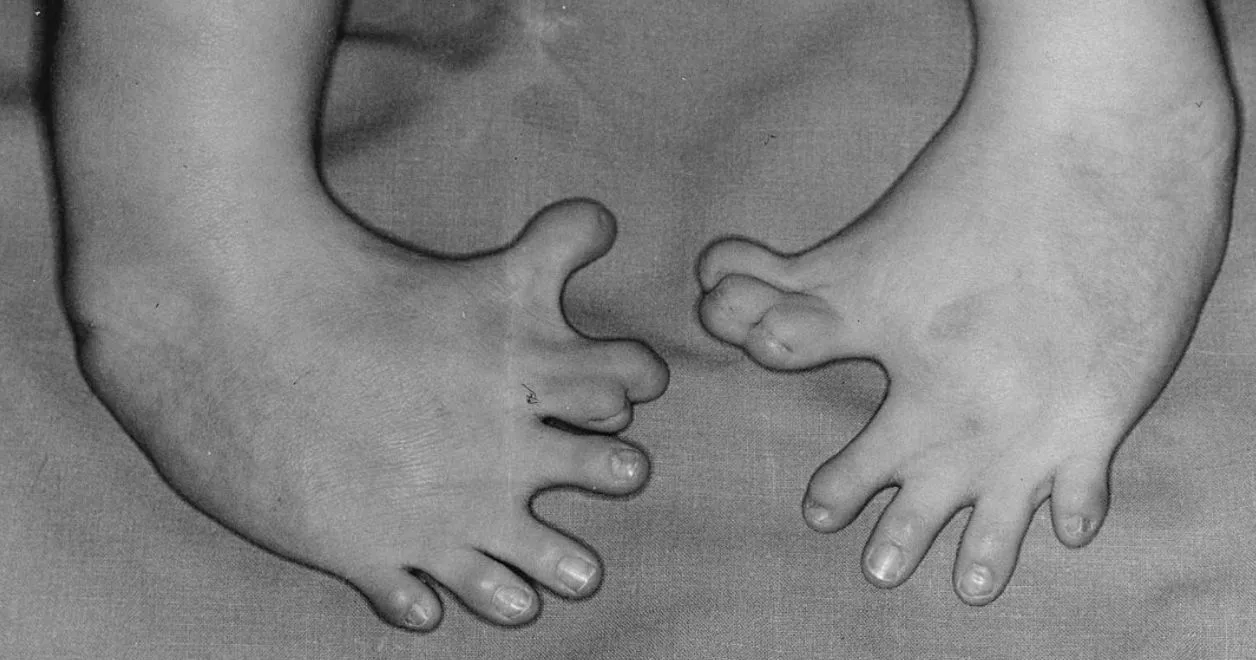 Polidaktylia u dziecka z embriopatią talidomidową