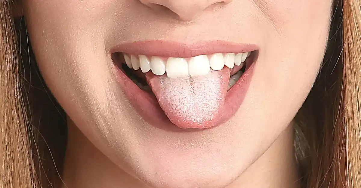 Biały nalot na języku często jest efektem niedbałości o czystość jamy ustnej