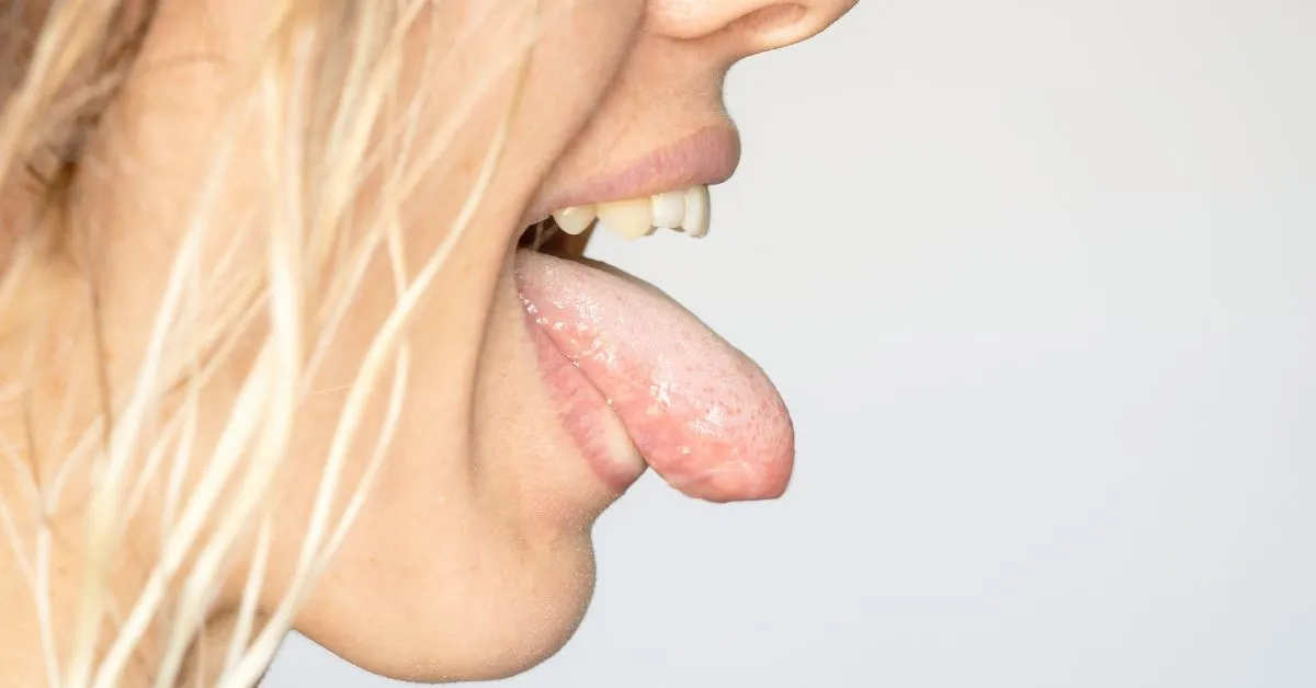 Biały nalot na języku może być objawem drożdżycy jamy ustnej