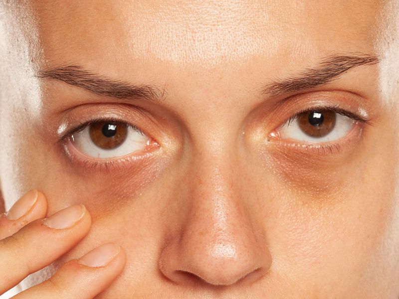 Objawy chorej wątroby - Podkrążone oczy