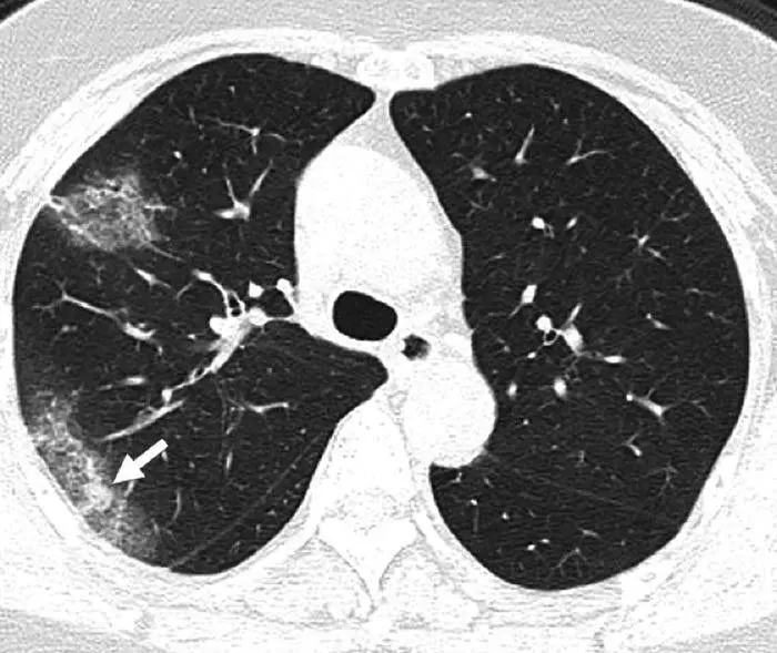 Koronawirus - Zmiany w płucach