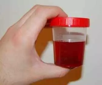 Krwiomocz