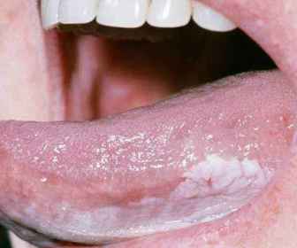 Leukoplakia