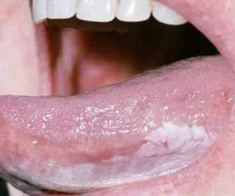Leukoplakia