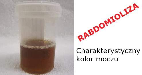Rabdomioliza - charakterystyczny kolor moczu