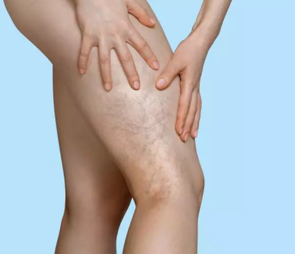 Pajączki na nogach - Czy mogą oznaczać poważne choroby?