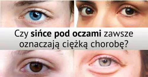 Sińce pod oczami - Czy oznaczają chorobę?