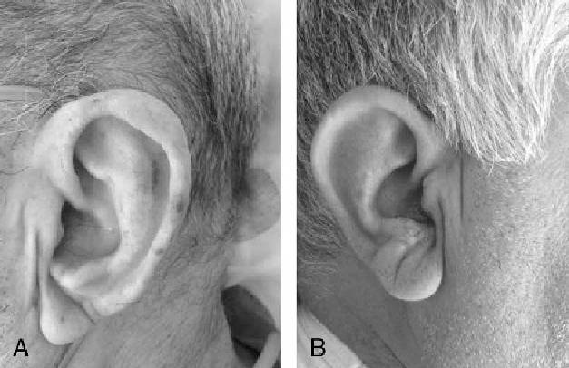 Znak Franka - Czy ta charakterystyczna zmarszczka na płatku ucha może oznaczać chorobę serca?