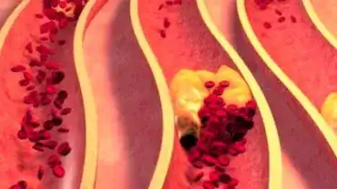 Udrażnianie tętnic - Dieta udrażniająca tętnice