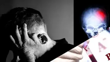 Grupa krwi - Wpływ na ryzyko udaru mózgu