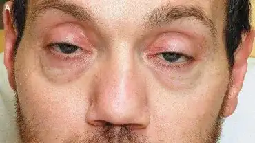 Botulizm - Czy żywność z puszek jest zdrowa?