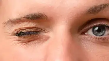 Drgająca powieka - Przyczyny