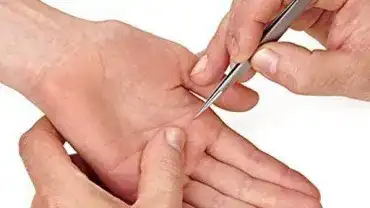 Drzazga - Czy może być niebezpieczna?