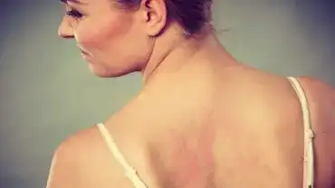 Trądzikowa mapa ciała