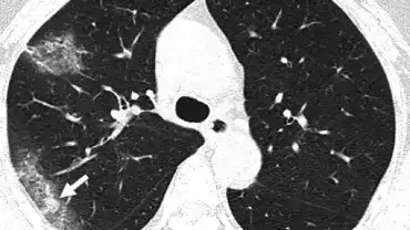 Koronawirus SARS-CoV-2 może nieodwracalnie uszkadzać płuca