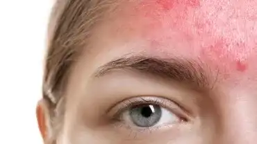 Pryszcze na twarzy - Co oznacza ten pryszcz?