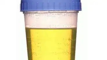 Co mocz mówi o zdrowiu? Wygląd moczu