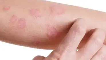 Zmiany skórne - Objawy chorej wątroby