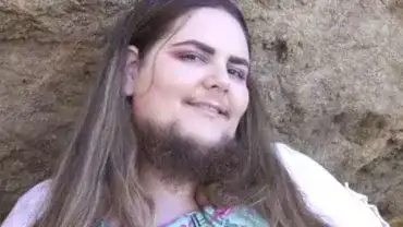 Hirsutyzm - Nadmierne owłosienie kobiecej twarzy