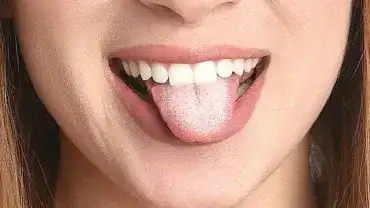 Co może oznaczać biały nalot na języku?