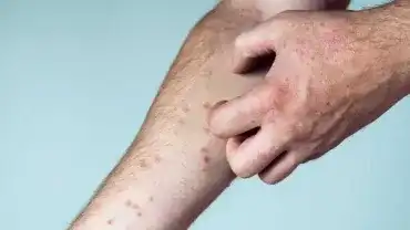 Swędząca skóra - Skutecznie sposoby