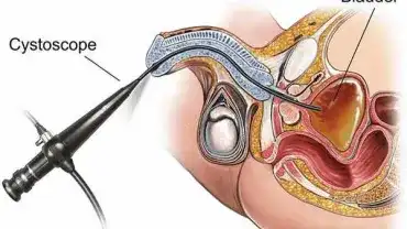 Cystoskopia Warszawa