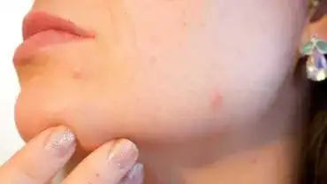 Trądzik - Problem estetyczny