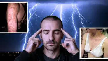 Niewyjaśnione skutki porażenia piorunem