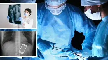 Najdziwniejsze przedmioty znalezione w... człowieku