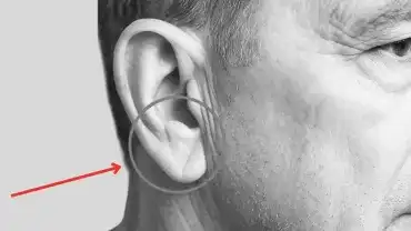 Zmarszczka na płatku ucha