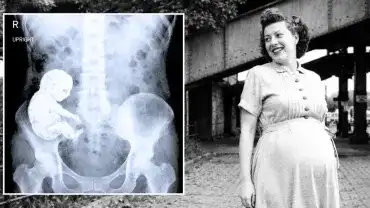 Lithopedion - Przypadek Zahry Aboutalib