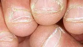 Poobgryzane paznokcie