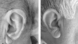 Znak Franka - Czy ta charakterystyczna zmarszczka na płatku ucha może oznaczać chorobę serca?