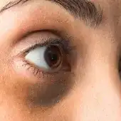Dlaczego robią się sińce pod oczami?