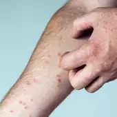 Swędząca skóra - Skutecznie sposoby
